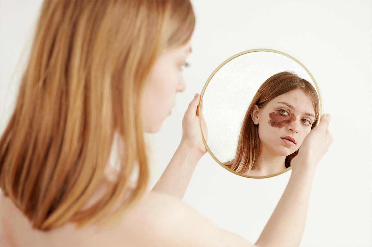 Birthmark Removal: The Must-Know Details