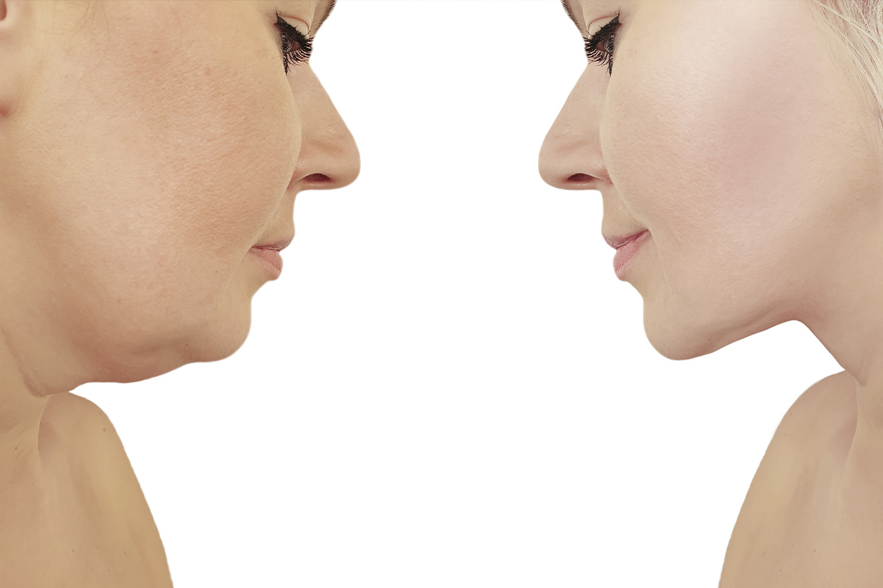 Double Chin Removal (Non-Surgical): Everything You Need to Know