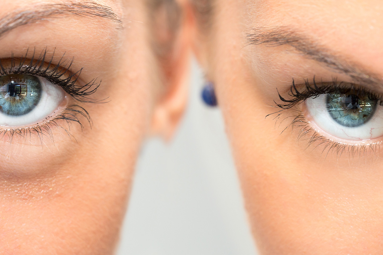 CO2 Laser and Chemical Peel Before and After Photos - Boston Eyelids