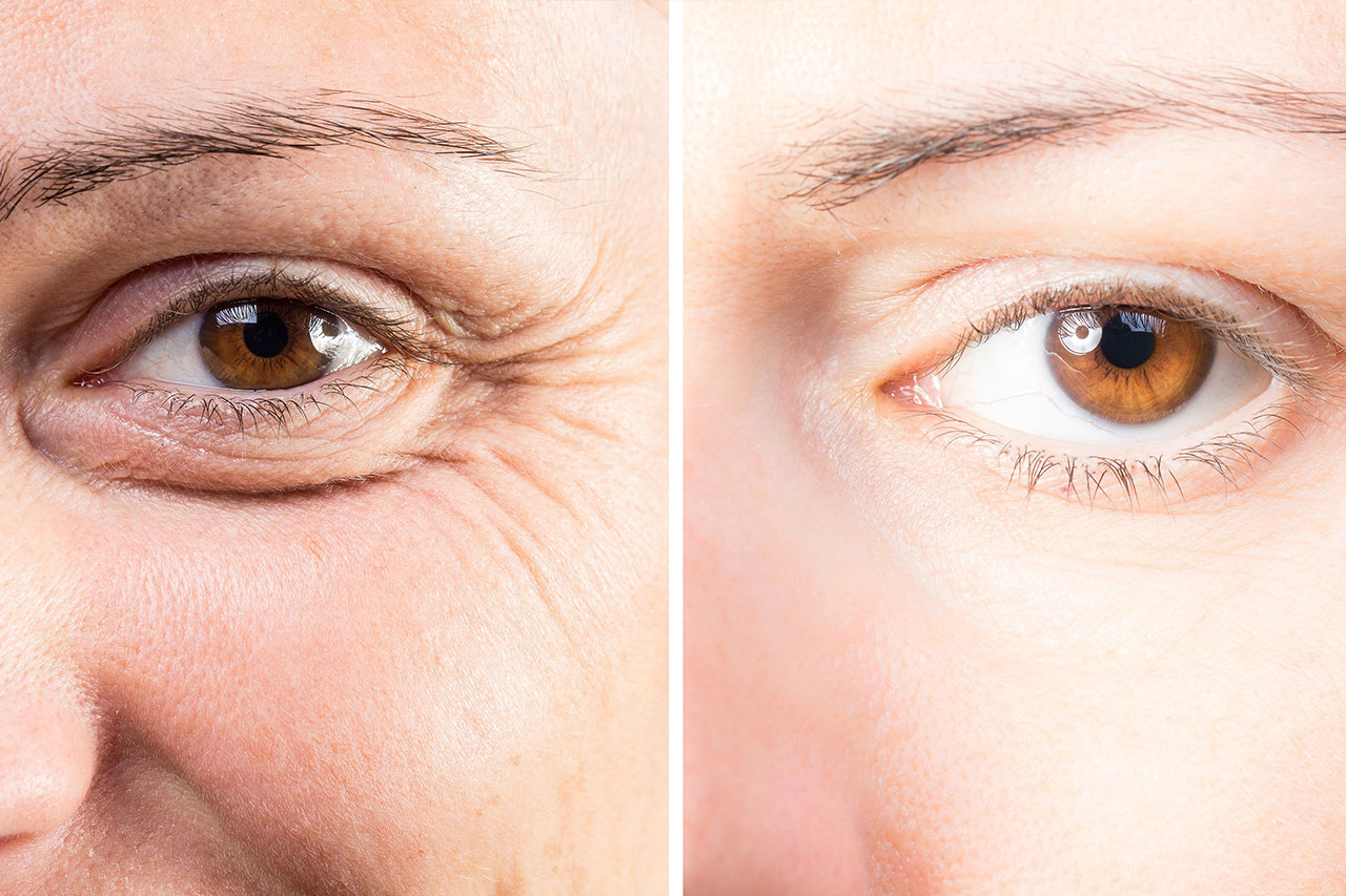 7 Ways to Get Rid of Under Eye Bags  Millennial Plastic Surgery