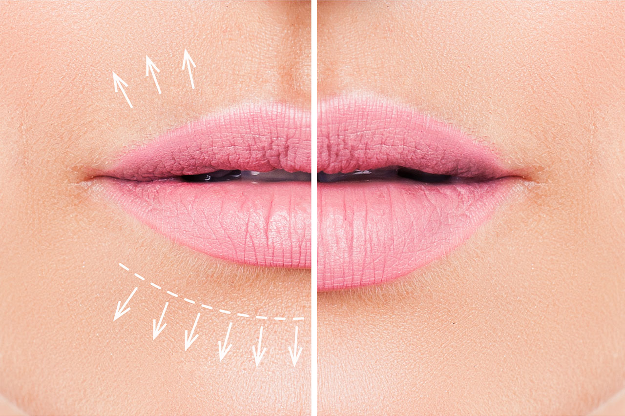 Lip Filler and Lip Augmentation: The Must-Know Details