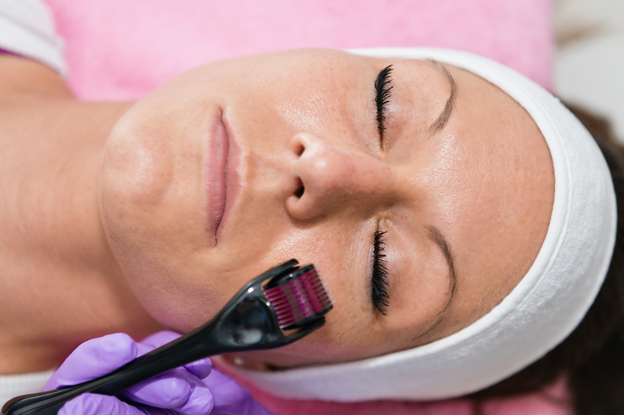 Microneedling: Smoother Skin for All