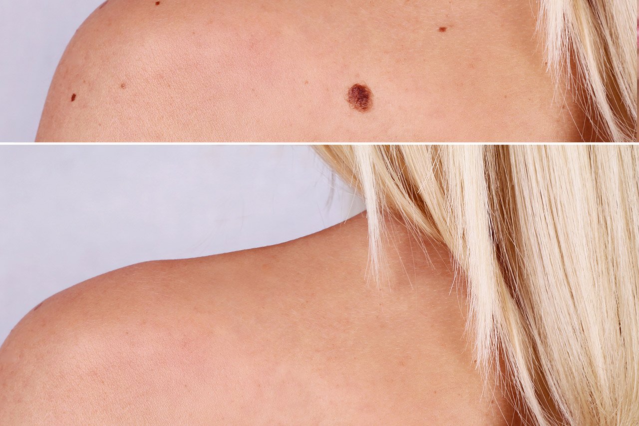 What Should You Know About Mole Removal?