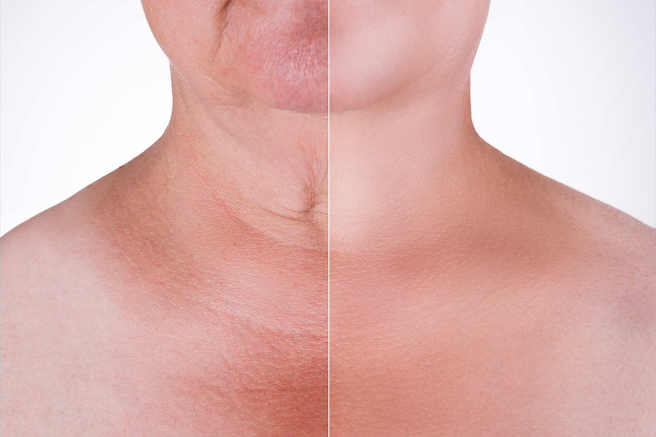 Non-Surgical Neck Lift: The Crucial Details