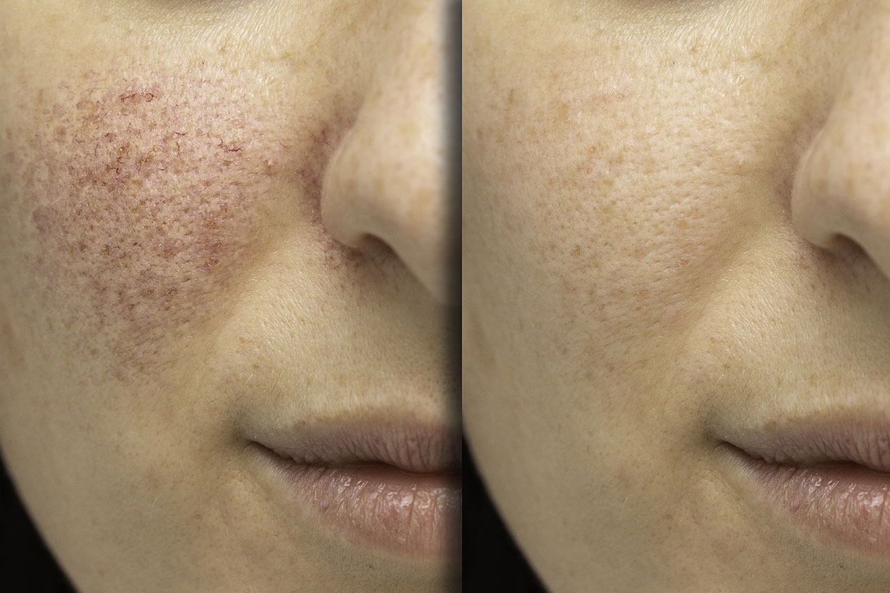Rosacea: The Important Details and Facts You Should Know