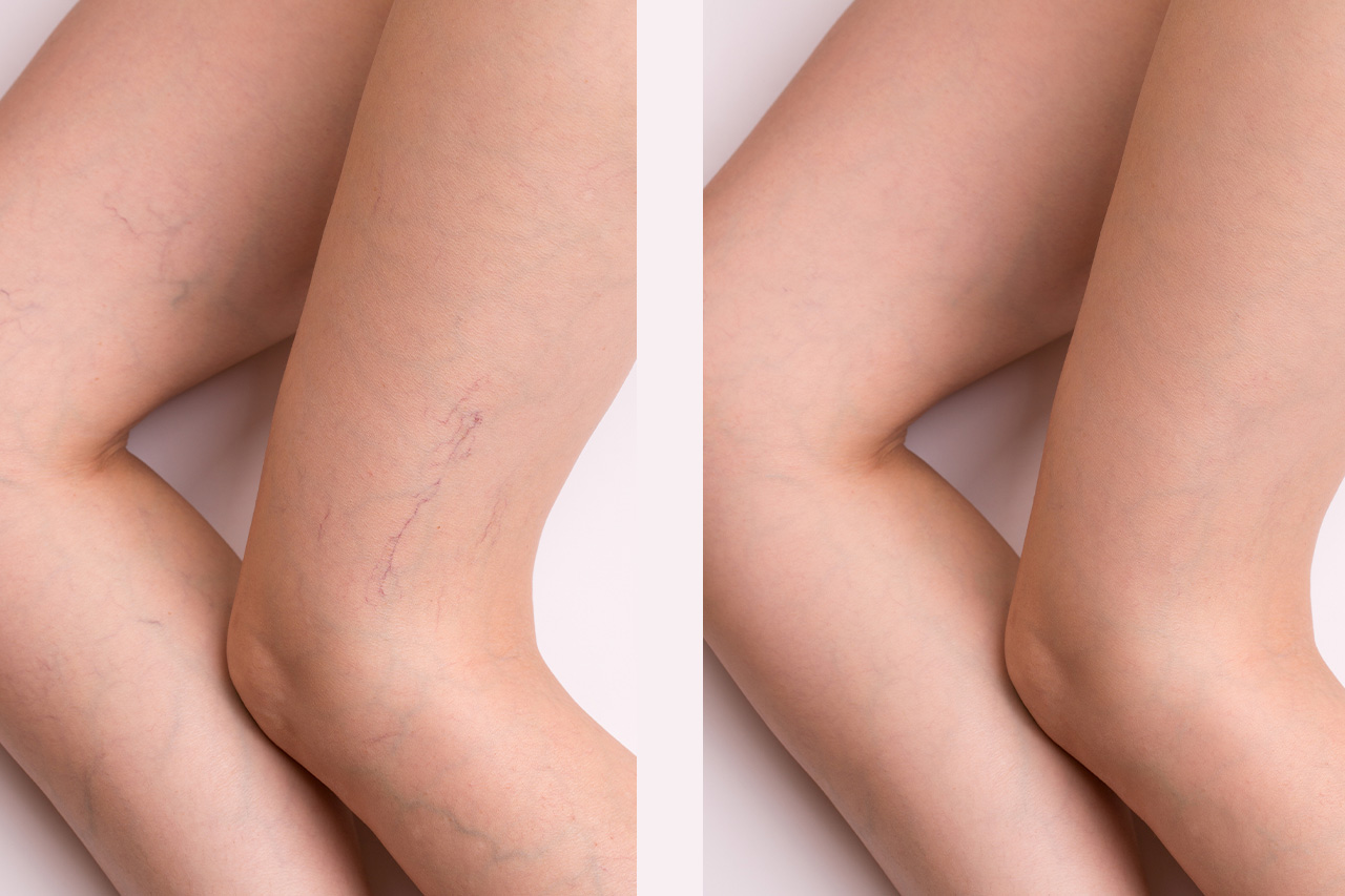 Spider Vein Removal: Eliminate Spider Veins Without Any Pain